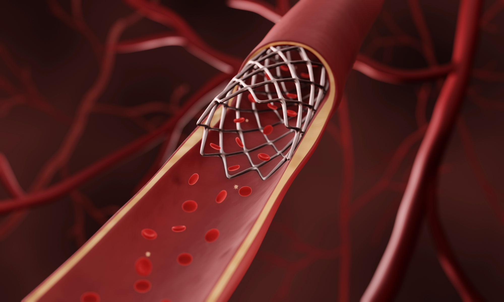 Low-Temperature-Activated Deployment of Smart 4D-Printed Vascular Stents